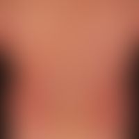 Morbilliformes Exanthem: wenige Tage altes, dichtes makulöses Virusexanthem mit Fieber, Abgeschla...
