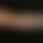 Vitiligo: on the upper part of the upper arm spatter-like vitiligo, on the forearm extensive depi...