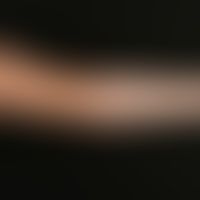 Vitiligo: am Oberm spritzerartige Vitiligoherde, am Unterarm flächenhafte Depigmentierung.
