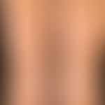 Vitiligo: multiple roundish or circine vitiligo foci, with the credible assurance that a melanocy...