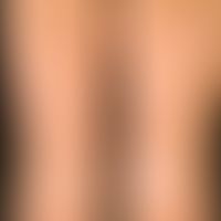 Vitiligo: multiple roundish or circine vitiligo foci, with the credible assurance that a melanocy...