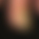 Retronychia: Pagoda-like nail growing forward and upwards. In the meantime the nail growth is com...