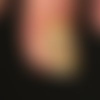 Retronychia: Pagoda-like nail growing forward and upwards. In the meantime the nail growth is com...