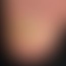 Retronychie: psoriatrische Onychodystrophie, mit weitegehender Zerstörung der Nagelplatte. Seit l...
