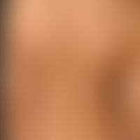 Vitiligo: Multiple predominantly roundish vitiligo foci. A foci with a central residue of a melan...