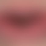 Rhagade of the lower lip in chronic cheilitis granulomatosa

