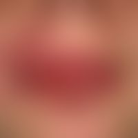 Mundwinkelrhagade bei Cheilitis granulomatosa.
