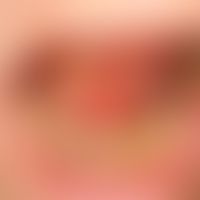Ranula: harmless and not painful, glassy cyst on the left side of the frenulum of tongue.
