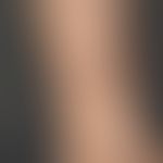 Giant comedo since several years existing, slowly enlarging knot with central black horn plug. No...