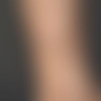 Giant comedo since several years existing, slowly enlarging knot with central black horn plug. No...