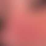 Nodules - Rhinophyma described: since 2 years increasing, symptomless localized phymogenesis on t...