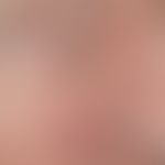 Nodules: nodular basal cell carcinoma, slowly growing, skin-coloured with bizarre vessels at the ...