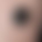 Nodule: Melanoma, malignant, nodular. " Always present", solitary, asymptomatic, growing for more...