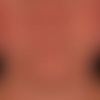 Lupus erythematodes systemischer: nach Sonnenlichteinwirkung sich deutlich verschlechternder Befu...