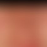 Systemischer Lupus erythematodes: lichtprovozierbare, symmetrische Erytheme und rote&nbsp;Plaques...