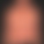Lupus erythematodes systemischer: chronisches, UV-provoziertes, ortskonstantes&nbsp;makulo-papulö...