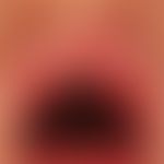 Lupus erythematodes (Übersicht): systemischer Lupus erythematodes. Zahlreiche kleinere, schmerzha...