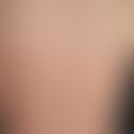 Lupus erythematodes, subakut-kutaner Lupus erythematodes: akuter Schub eines nicht vernarbenden, ...
