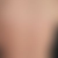 Lupus erythematosus, subacute cutaneous lupus erythematosus: acute episode of non-scarring cutane...