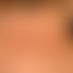 Lupus erythematodes (Übersicht): nicht vernarbender, chronischer Lupus erythematodes der Haut (Lu...