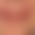 Lupus erythematodes chronicus: chronischer, kutaner Lupus erythematodes mit schuppigen berührungs...