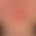 Kutaner Lupus erythematodes: chronischer, kutaner Lupus erythematodes bei einer Adoleszenten.
