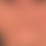 Lupus erythematodes: kutaner chronischer (vernarbender) Lupus erythematodes (chronisch diskoider ...