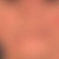 Lupus erythematodes: kutaner chronischer (vernarbender) Lupus erythematodes (chronisch diskoider ...