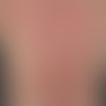 Rowell-Syndrom: Erythema exsudativum multiforme-artiges&nbsp;&nbsp;Exanthem bei "subakut kutanem ...