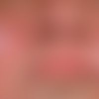 Lupus erythematodes (Kutaner Lupus erythematodes): seit mehreren Jahrzehnten bestehender, schubwe...