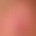Lupus erythematodes kutaner (Übersicht): chronisch diskoider Lupus erythematodes mit mutilierende...