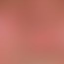 Lupus erythematodes kutaner (Übersicht): chronisch diskoider Lupus erythematodes. Beachte das Neb...