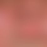 Lupus erythematodes kutaner (Übersicht): chronisch diskoider Lupus erythematodes. Beachte das Neb...