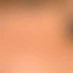 Lupus erythematodes tumidus: seit längerem bestehende, regellos verteilte, scharf begrenzte, 0,2-...