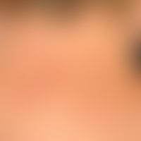 Lupus erythematodes tumidus: long-standing, irregularly distributed, sharply defined, 0.2-3.0 cm ...