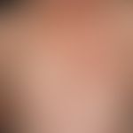 Lupus erythematodes subakut kutaner (Rowell`s Sydrom): seit mehreren Wochen bestehende, symmetris...