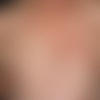 Lupus erythematosus subacutely cutaneous (Rowell's sydrome): symmetrical, up to 3.0 cm large, par...