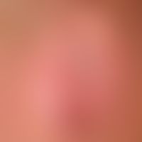 Lupus erythematodes chronicus discoides: bizarrely limited white (follicular) scar with injected ...