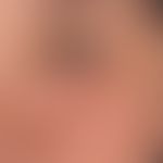 Lupus erythematodes chronicus discoides: 35- Jahre alte ansonsten gesunde Patientin. Hautveränder...