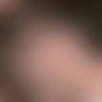 Lupus erythematodes chronicus discoides: älterer nicht&nbsp;(mehr) aktiver, unter Atrophie von Ha...