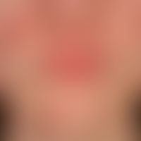 lupus erythematodes chronicus discoides: 18-year-old otherwise healthy patient. skin lesions sinc...