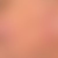 Lupus erythematodes chronicus discoides: dry-scaling, red, hyperesthetic, plaques with adherent s...