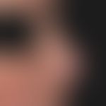 Lupus erythematodes chronicus discoides: zu deutlichen Mutilationen&nbsp;führender CDLE.&nbsp;Atr...