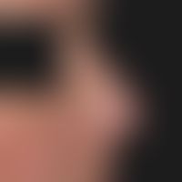 Lupus erythematodes chronicus discoides: CDLE leading to significant mutations, atrophy of skin a...
