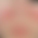 Lupus erythematodes chronicus discoides: 13 Jahre alte ansonsten gesunde Patientin. Hautveränderu...