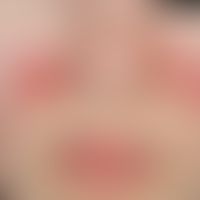 Lupus erythematodes chronicus discoides: 13 Jahre alte ansonsten gesunde Patientin. Hautveränderu...