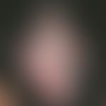 Lupus erythematodes chronicus discoides. Seit 4 Jahren bestehende Alopezie. Multiple, kleinere un...