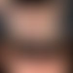 Lupus erythematodes chronicus discoides: Zustand nach 2-jähriger Dauertherapie mit &nbsp;Resochin.
