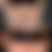 Lupus erythematodes chronicus discoides: Condition after 2 years of continuous therapy with Resoc...