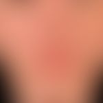 Lupus erythematodes chronicus discoides: 25- Jahre alte ansonsten gesunde Patientin. Wechselhafte...